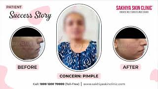 Acne Treatment  Real Acne Treatment Success Story amp Review  Sakhiya Skin Clinic [upl. by Varuag]