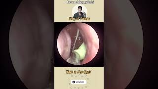 귀지형 콧물 부비동염 축농증 비염 코청소 이비인후과 rhinorrhea rhinitis sinusitis ASMR [upl. by Hindorff]