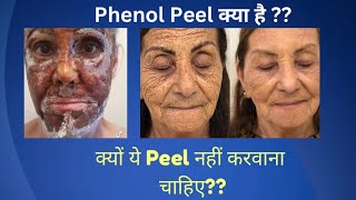 जानिये Phenol Peel के बारे में  what is Phenol Peel [upl. by Nelly]