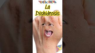 La Dishidrosis 😱 Explicado shortvideo [upl. by Annoed]