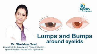 Lumps amp Bumps around Eyelids  Dr Shubhra Goel  Apollo Hospital [upl. by Chloras]