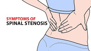 Symptoms of Spinal Stenosis [upl. by Amarette]