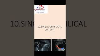 Single umbilical artery  What should we do SUA [upl. by Nywroc]