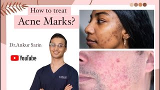 Acne Marks treatment  Acne treatment Dermatologist  Lasers and peels  Dr Ankur [upl. by Ayanad]