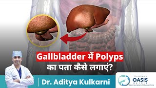 Gallbladder में Polyps का पता कैसे लगाएं  Dr Aditya Kulkari [upl. by Rabiah722]