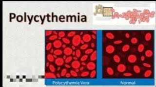 Polycythemia Definition of polycythemiaTypes of polycythemia💯💯 [upl. by Ocinemod]