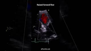 Pulmonary Stenosis 🩵 echocardiogram echocardiography cardiology PulmonaryValve congenital [upl. by Lefton]