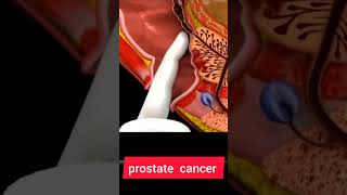 PROSTATE CANCER  PROSTATE CANCER ANIMATION howtogetsuccessinlife biologyislife getsuccess [upl. by Olethea]