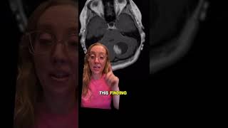 Case study 124  Pilocytic astrocystoma EXPLAINED by a boardcertified neurosurgeon [upl. by Fulviah]