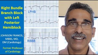 Right bundle branch block with left posterior hemiblock [upl. by Nalym]