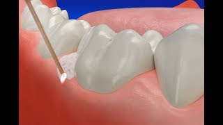 How Gum Disease Treatment Laser works [upl. by Nitas]