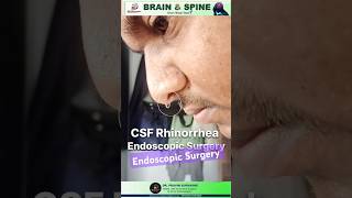 CSF rhinorrhea endoscopicspinesurgery shortvideo pune hospital neurosurgeon in [upl. by Anitan884]