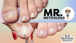 Impacted Toenail PEDICURE Cleaning on Mr Meticulous [upl. by Anatol]