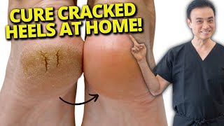 7 Cracked Heel Home Remedies That REALLY Work [upl. by Ahsimet]