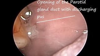 Disorder of Salivary Gland  Pus discharge from parotid duct opening Acute Suppurative Parotitis [upl. by Elolcin904]