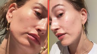 Hailey Bieber Goes FilterFree to Show Her Pimples [upl. by Anirroc790]