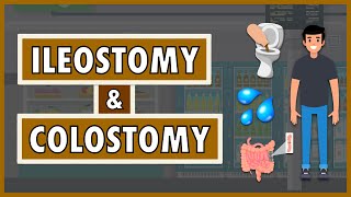 Ileostomy and Colostomy  Emphasis on DietNutrition [upl. by Peterson]