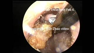 3 simple cholesteatoma clearance in the external auditory canal 10 min [upl. by Nuzzi]