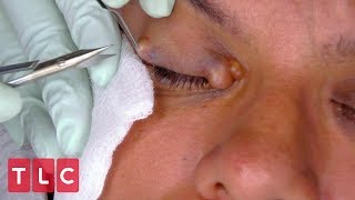 Dr Lee Removes Hildas Hidrocystoma  Dr Pimple Popper [upl. by Annael970]