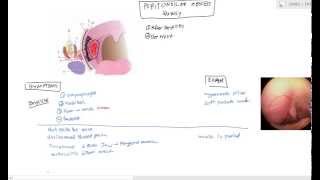 Peritonsillar Abscess Quinsy for USMLE Step 2 [upl. by Edora]