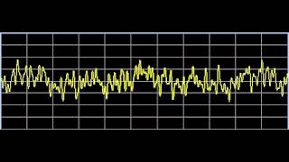 Thalamic Diseases  Rife Frequencies [upl. by Walley]