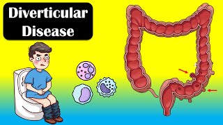 Diverticular Disease And Diverticulitis  Causes Signs amp Symptoms Diagnosis Treatment [upl. by Uamak]