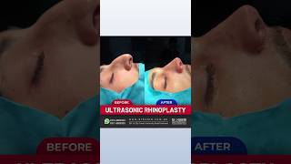 Rhinoplasty Before and After  Transformation Success [upl. by Raney571]