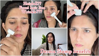 Derma stamp benefits for hair fall amp aging  Hairfall guide by Natasha waqas [upl. by Roxine]