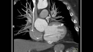 Cardiac 4D Reconstruction of patient with prior myocardial infarction 2 of 4 [upl. by Ayila338]