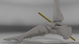 Over Pronation amp Supination Motion Biomechanics of the Subtalar Joint Explained [upl. by Dlonra]