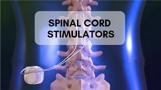 SPINAL CORD STIMULATOR [upl. by Anina]