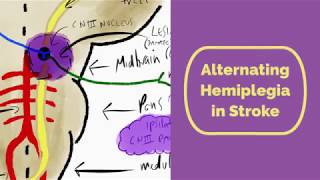 Alternating Hemiplegia in Stroke [upl. by Aihsiek349]