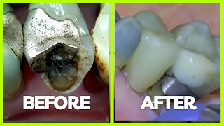 44 Fractured Tooth Repaired with Crown [upl. by Sparrow]