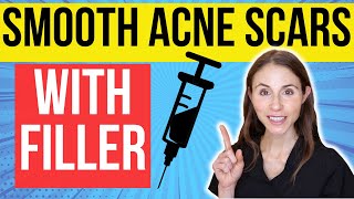 Filler For Acne Scars  Dermatologist Explains [upl. by Rol]