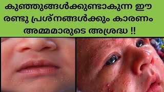 Causes And Home Remedies To Treat Baby Acne And Miliaകുഞ്ഞുങ്ങൾക്കുണ്ടാകുന്ന skin problems [upl. by Eeuqram]