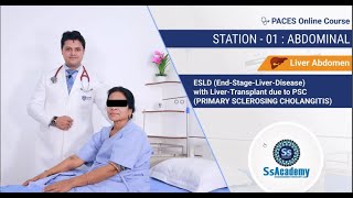 PACES 2023 New Format  Station  01 EndStage  Liver  Disease with LiverTransplant due to PSC [upl. by Gibbs]