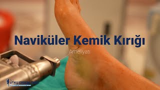 Ayakta Naviküler Kemik Kırığı Ameliyatı  Op Dr Utku Erdem Özer [upl. by Susie527]