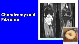 Chondromyxoid fibroma  A short summary of a strange benign tumor [upl. by Lilli938]