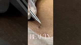 Long Ingrown Hair Removal [upl. by Yelrahs532]