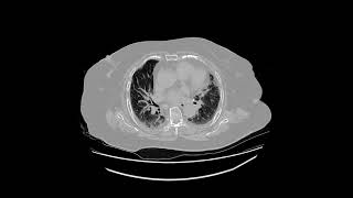 honeycomb lung [upl. by Medovich]