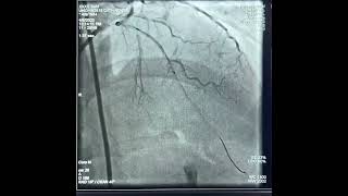 Superdominant RCA 100 stenosis LAD CTO PCI [upl. by Suelo]