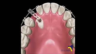 Canine Impaction dentistbracing orthodonticscanineimpactionImpactionExposureCanineexposure [upl. by Imelida993]