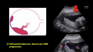 Ultrasound Imaging of the placenta Part 1 Anatomy and Variants [upl. by Tol]