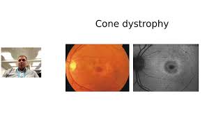 An overview of cone dystrophies with Thales AC de Guimarães [upl. by Nnaj965]