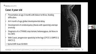 Tethered Cord with Surgical Detethering an UnderRecognised Comorbidity  Dr Sandrine Cornaz Buros [upl. by Tertia]