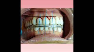 Gingivectomy after 10 days [upl. by Aggri755]