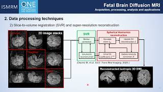 Fetal Brain Diffusion MRI [upl. by Berta]