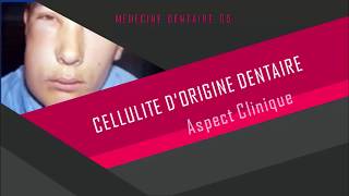 Cellulite dorigine dentaire  Part 1 [upl. by Ally]