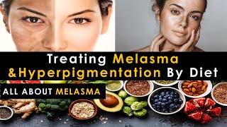 Melasma Cure Diet  Treat Melasma amp HyperPigmentation By Diet  Treat Melasma Naturally [upl. by Nosemaj]