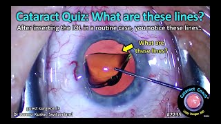 CataractCoach™ 2235 What are these lines after IOL insertion [upl. by Bodkin]